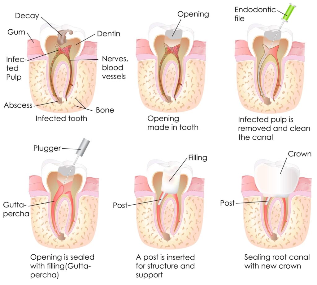 Root-Canal-Treatment